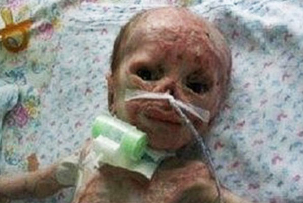 سوختن نوزاد 3 روزه در دستگاه فتوتراپی بیمارستان/ والدین سنگدل نوزاد بی‌گناه را در بیمارستان رها کردند + تصاویر