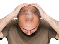 بیشتر دلیل ریزش مو در مردان و زنان