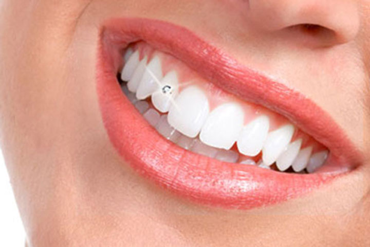 مدهای زیبایی چه بر سر دندان های تان می آورند؟
