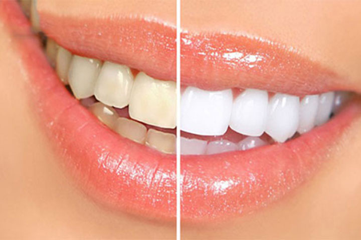 بهترین روش جلوگیری از پوسیدگی دندان