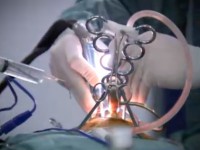 مهره های گردنی پرینت شده برای نخستین بار درون بدن یک بیمار کار گذاشته شدند