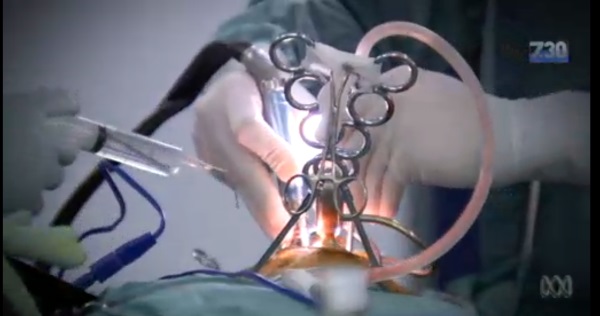 مهره های گردنی پرینت شده برای نخستین بار درون بدن یک بیمار کار گذاشته شدند