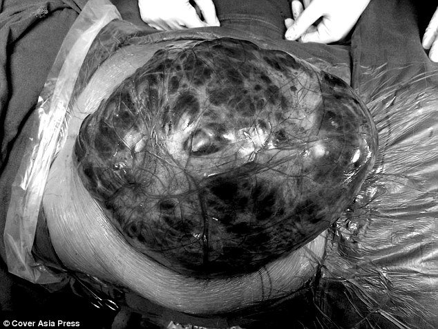 غده ۷ کیلویی در شکم یک زن (+عکس)