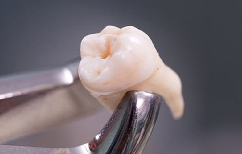 درمان حفره‌های دندان بدون پر کردن