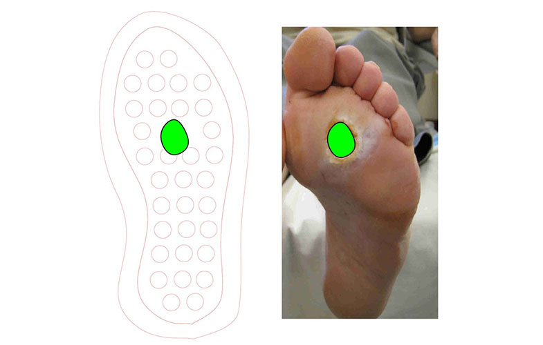 کفی مخصوص برای درمان زخم پا در افراد دیابتی (+عکس)
