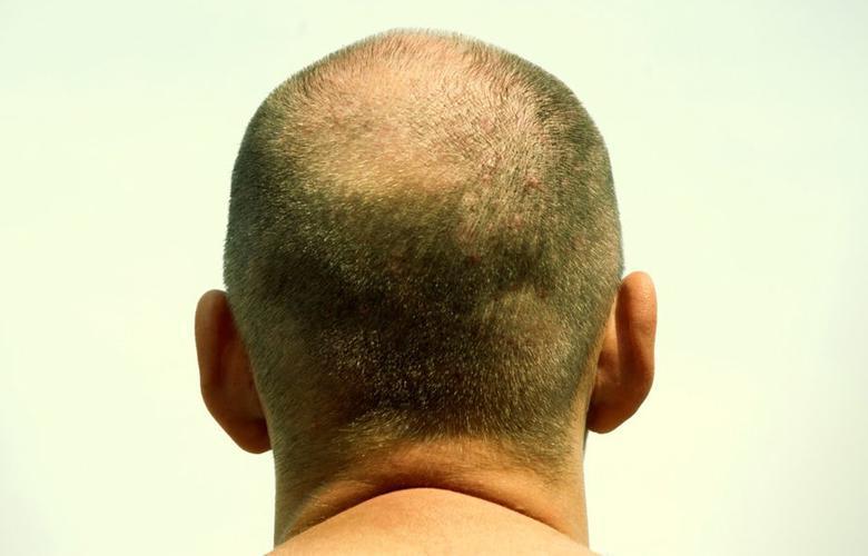 درمان قطعی ژاپنی‌ها برای رویش دوباره موهای افراد طاس (+عکس)