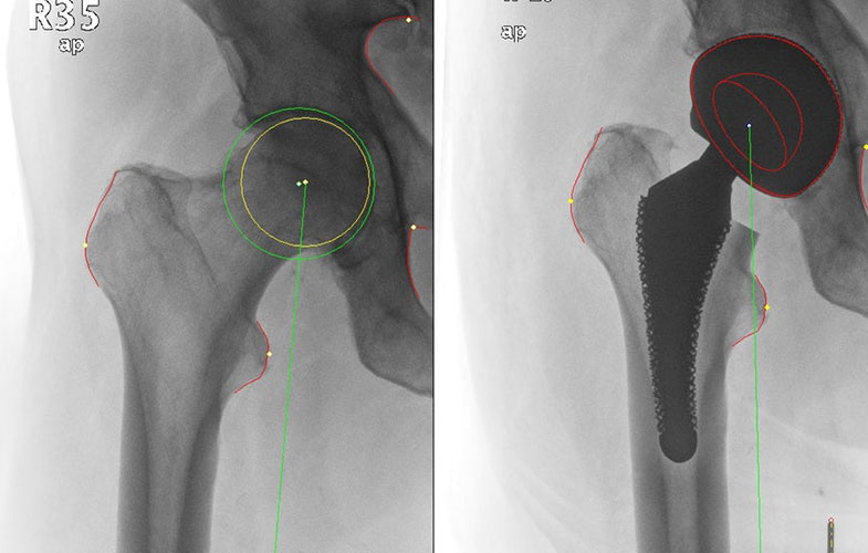 adjustable length artificial hip 2