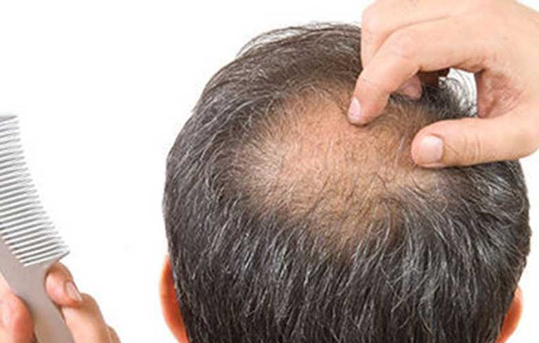 محققان: نوشیدنی گازدار باعث ریزش موی زودرس می‌شود