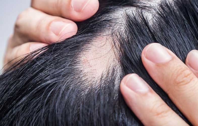 داروی جدید «فایزر» برای درمان ریزش مو