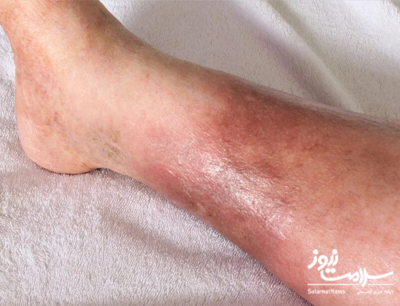 علائم هشدار دهنده «بیماری کلیوی» که روی پوست ظاهر می‌شوند