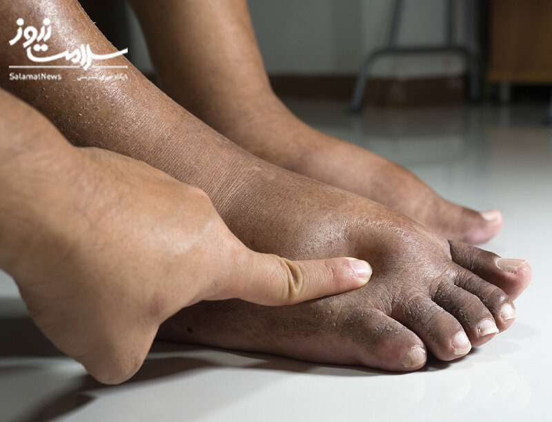 علائم هشدار دهنده «بیماری کلیوی» که روی پوست ظاهر می‌شوند