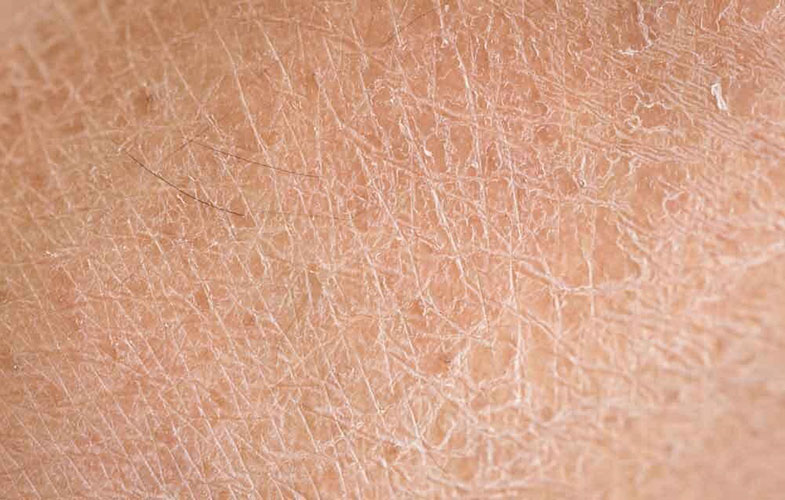 راه های تضمینی درمان خشکی پوست