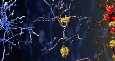 کشف عامل جدیدی در بیماری آلزایمر پس از کالبد شکافی مغز