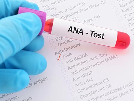 آزمایش ANA؛ یک آزمایش خون ساده برای تشخیص بسیاری از بیماری های خود ایمنی