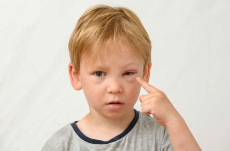 علل اصلی و درمان تورم چشم در کودکان
