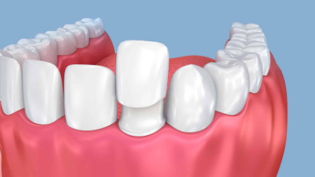 افتادن روکش دندان: علت‌ها، عواقب و راه‌های پیشگیری