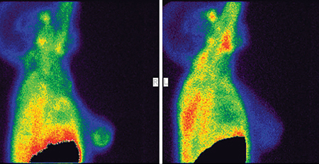 سینتی ماموگرافی: روش نوین تشخیص سرطان سینه