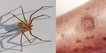 علایم نیش عنکبوت و روش‌های پیشگیری و درمان