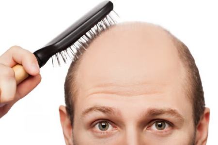 ژن‌های نادر عامل ریزش موی مردان