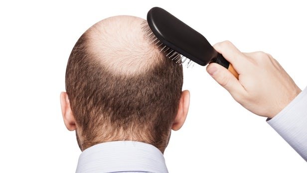 ۶ ریزمغذی موثر در جلوگیری از ریزش مو