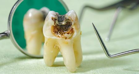 پوسیدگی دندان را فراموش کنید !