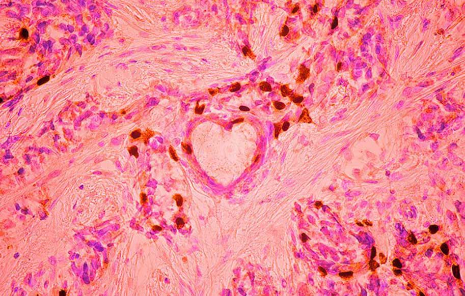 تصویر متفاوت از سلول های سرطان سینه!