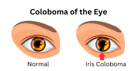 کولوبوم ؛ بیماری مادرزادی چشم